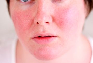 اگر صورتی لاغر می خواهید بخوانید | برای کاهش پف صورت این مواد غذایی را حذف کنید