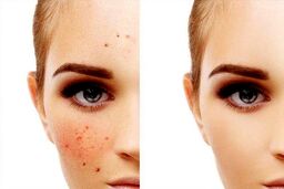 هنگام خرید ضد لک به چه نکاتی توجه کنیم؟