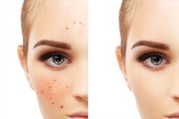 هنگام خرید ضد لک به چه نکاتی توجه کنیم؟