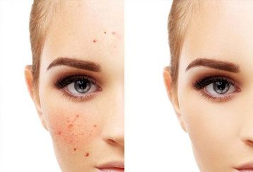 هنگام خرید ضد لک به چه نکاتی توجه کنیم؟