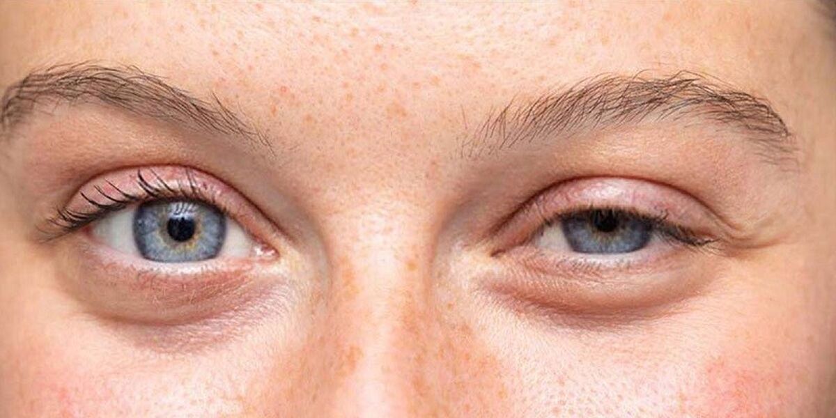 چطور از افتادگی پلک جلوگیری کنیم؟