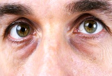 یک روش ساده برای از بین بردن سیاهی زیر چشم