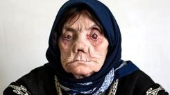 آمار ترسناک مبتلایان جذام در ایران | ۳ نشانه‌ اصلی بیماری