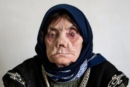 آمار ترسناک مبتلایان جذام در ایران | ۳ نشانه‌ اصلی بیماری