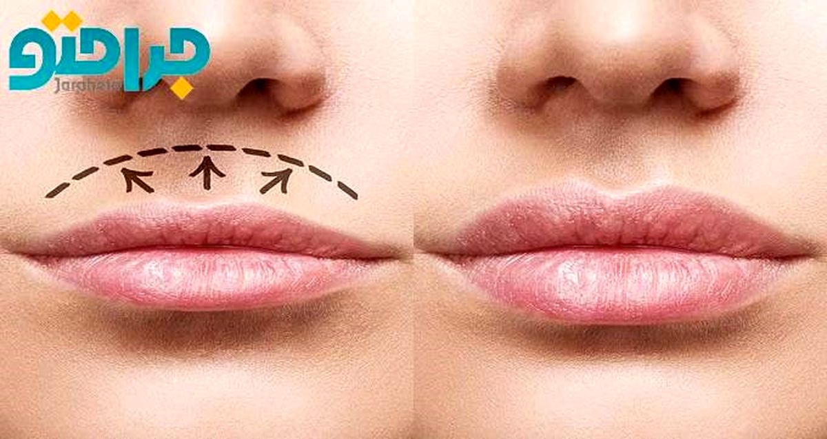 هزینه عمل جراحی سانترال لب در تهران