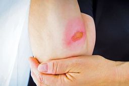 درمان انواع سوختگی درجات مختلف به ساده ترین روش ها