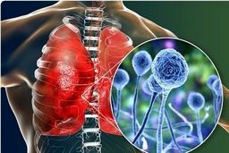  بیماری قارچ سیاه چیست؟+جزئیات بیشتر را بخوانید 