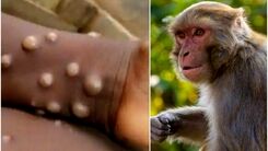 خبرهای بد از ویروس جدید|علائم وحشتناک ویروس آبله میمونی