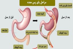 بای پس معده چیست؟