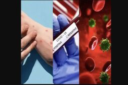 اتفاق دردناک برای این مرد ایتالیایی | همزمان دچار کرونا، آبله میمونی و ایدز شد!