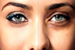 چگونه سیاهی دور چشم را ازبین ببریم؟