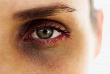 روش‌های خانگی برای نابودی سیاهی دور چشم!