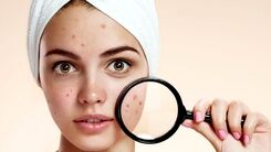 چگونه جوش های صورت را از بین ببریم؟
