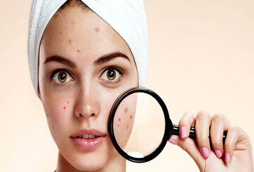 چگونه جوش های صورت را از بین ببریم؟