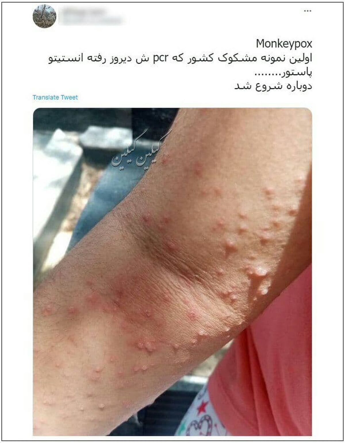 آبله میمونی به ایران رسید؟ | انتشار تصویر یک کودک ایرانی مشکوک به آبله میمونی
