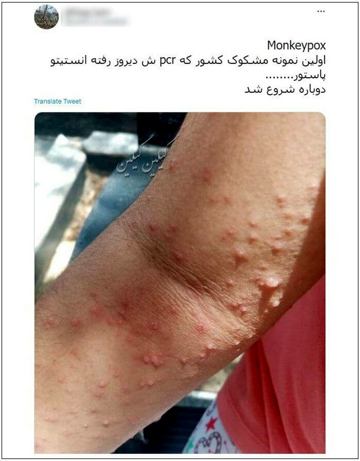  سرایت  هوایی آبله میمونی چقدر است؟