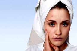 نابودی جوش صورت در یک روز