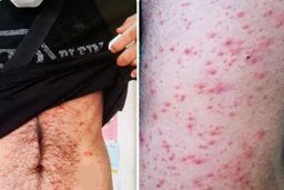 اولین آبله میمونی در تهران+عکس