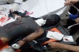 انفجار ترقه دو دست نوجوانی را قطع کرد | حاوی صحنه دلخراش 