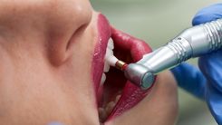 اهمیت پولیش دندان پس از کامپوزیت