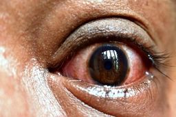 افزایش بیماران قارچ سیاه در ایران | هشدار جدی