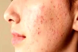 اگر صورتتان پُر جوش و آکنه است بخوانید | این ویتامین برای جوش و آکنه معجزه می‌کند