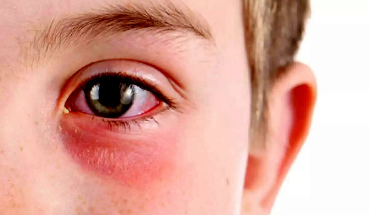 تعطیلی یک هفته ای مدارس به دلیل شیوع عفونت چشم |  راه های سرایت این بیماری خطرناک