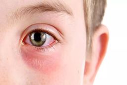 تعطیلی یک هفته ای مدارس به دلیل شیوع عفونت چشم |  راه های سرایت این بیماری خطرناک