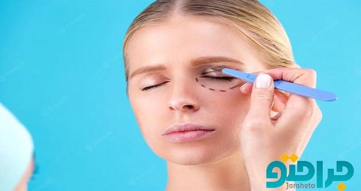 هزینه جراحی بلفاروپلاستی در سال 1401 چقدر است ؟