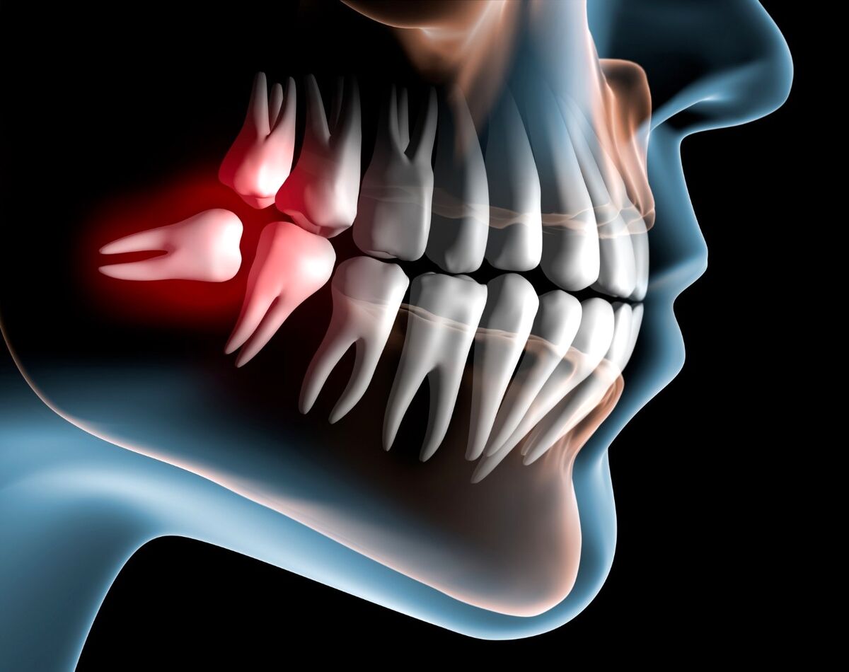 دندان عقل چه زمان باید کشیده شود؟